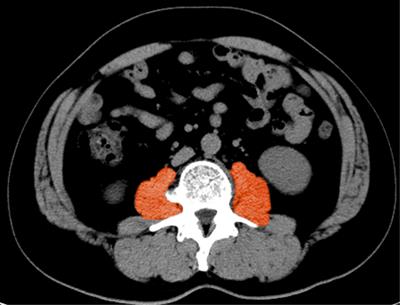 The clinical significance of sarcopenia in patients with hepatocellular carcinoma treated with lenvatinib and PD-1 inhibitors